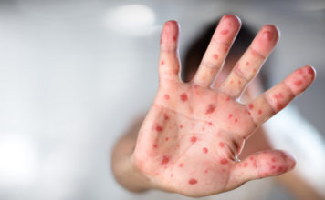 В семьях верующих в Запорожской области дети заразились опасным вирусом