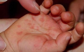 По Запорожской области продолжает распространяться опасная болезнь