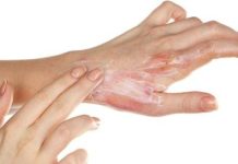 В Запорожской области люди по неосторожности получили серьезные ожоги